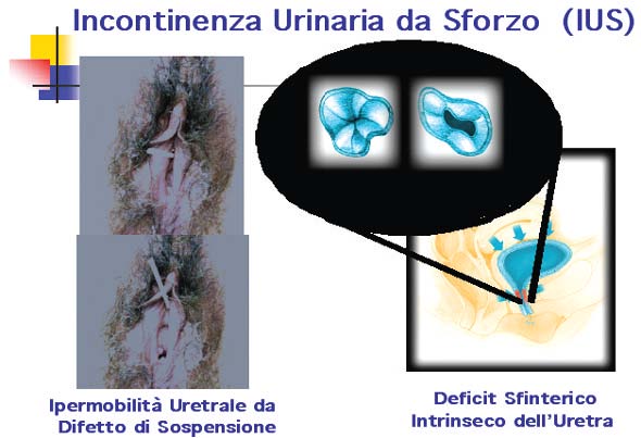 Incontinenza urinaria da sforzo (IUS)